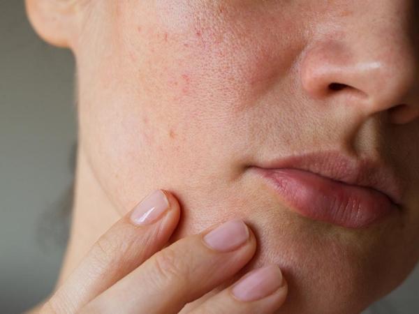 15 روش درمان کدری پوست صورت در خانه